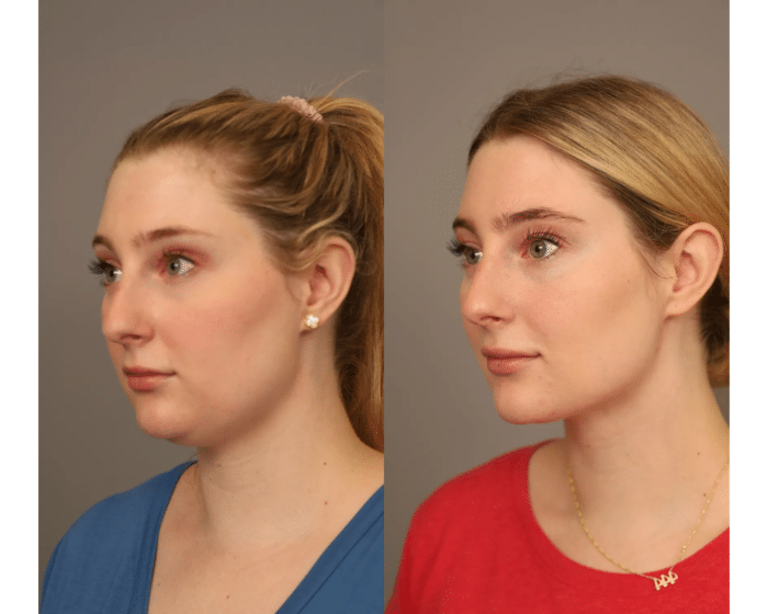 Chin liposuction before and after